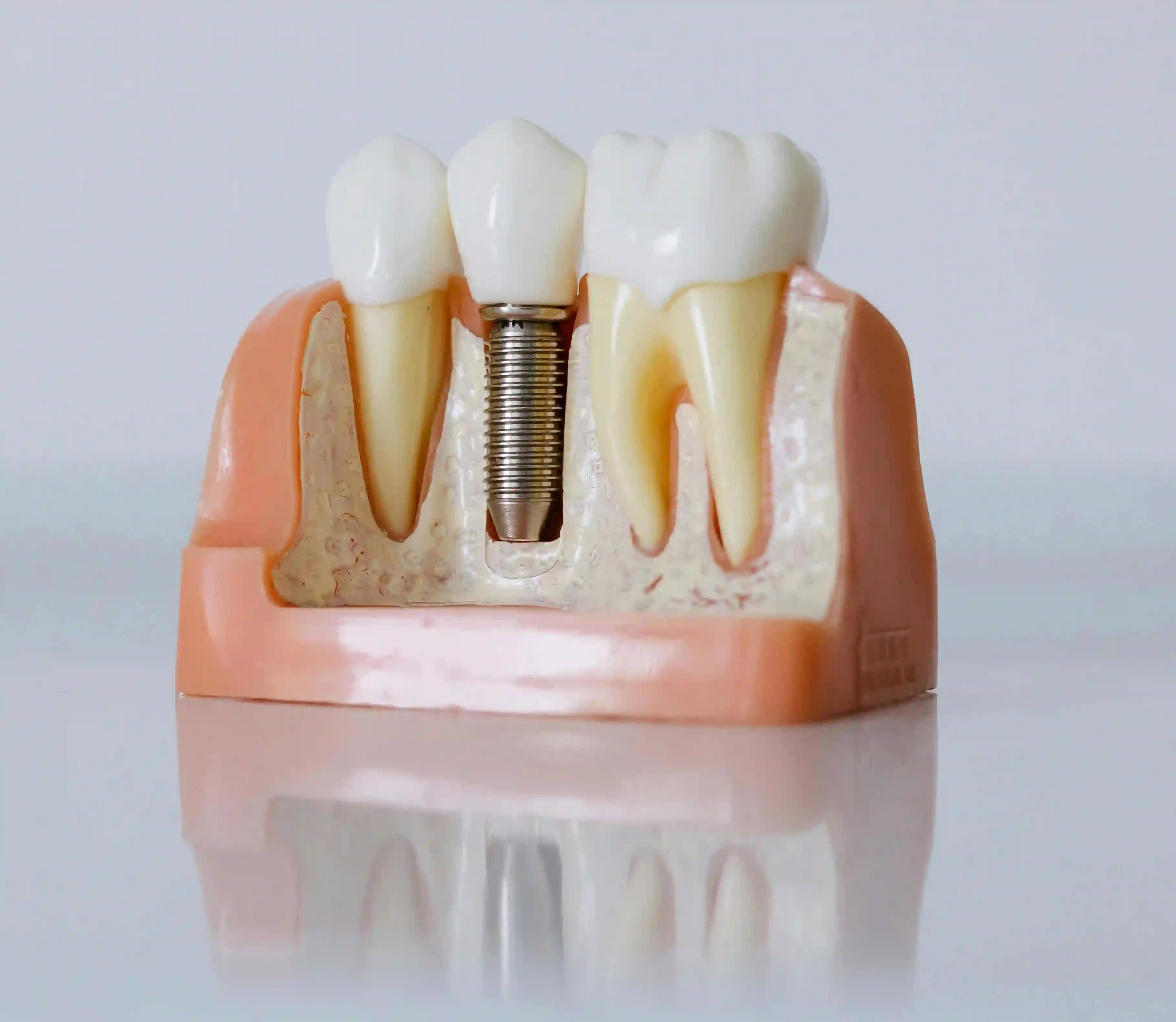Dental Implants service at PanOral Clinic